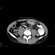 Crohn's disease of the small bowel: CT - Computed tomography